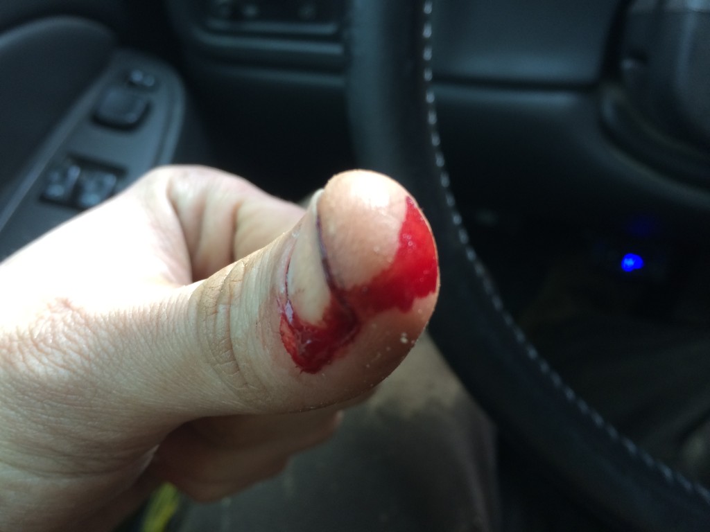 Bloody thumb from a pig injury